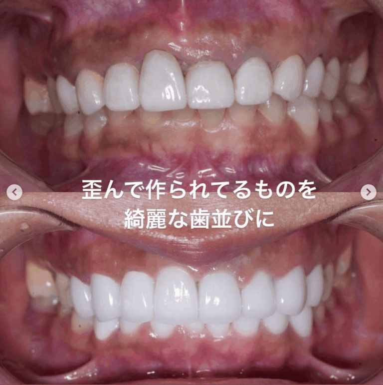 セラミック矯正