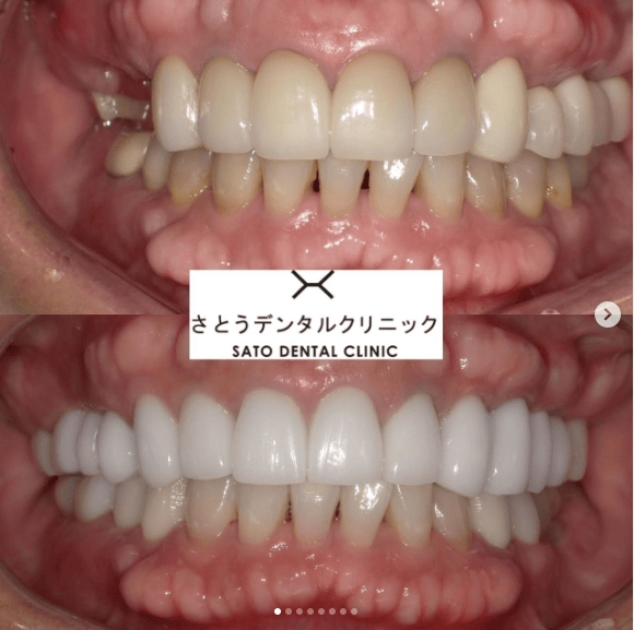 Case018 – セラミック矯正