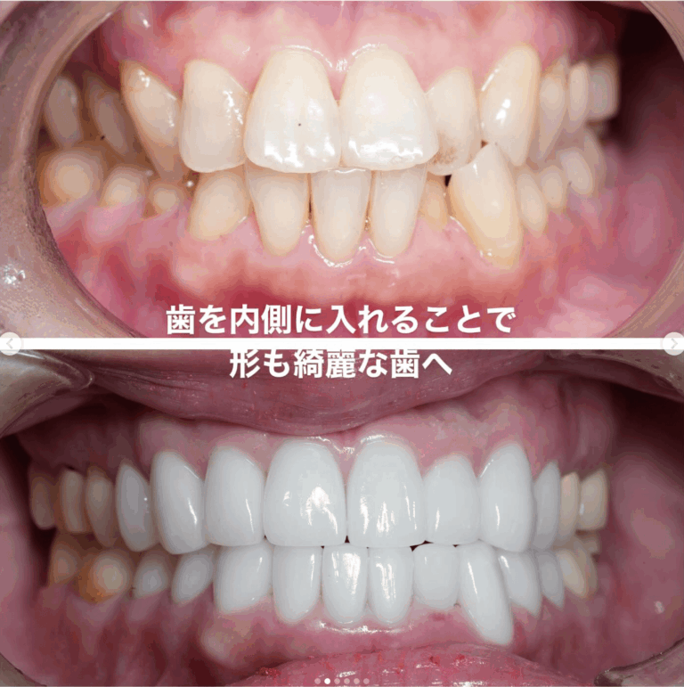セラミック矯正