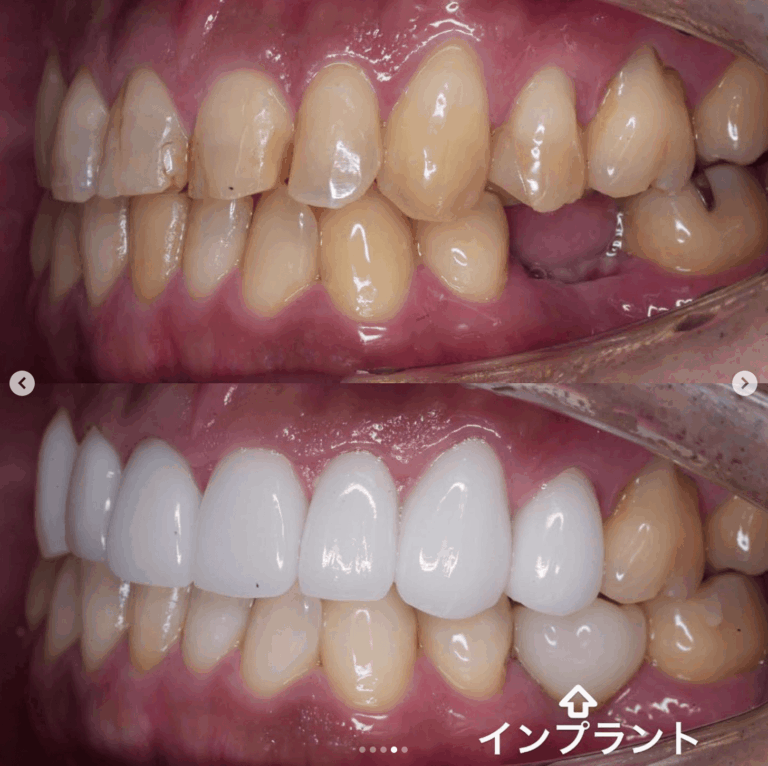 症例写真 ホワイトニング / セラミック矯正 / インプラント