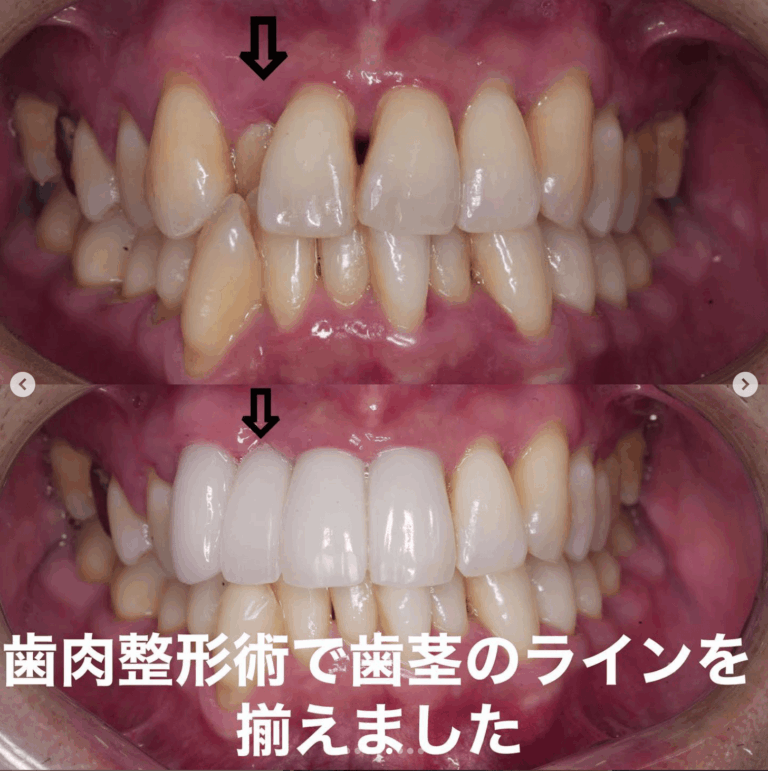 症例写真 セラミック矯正