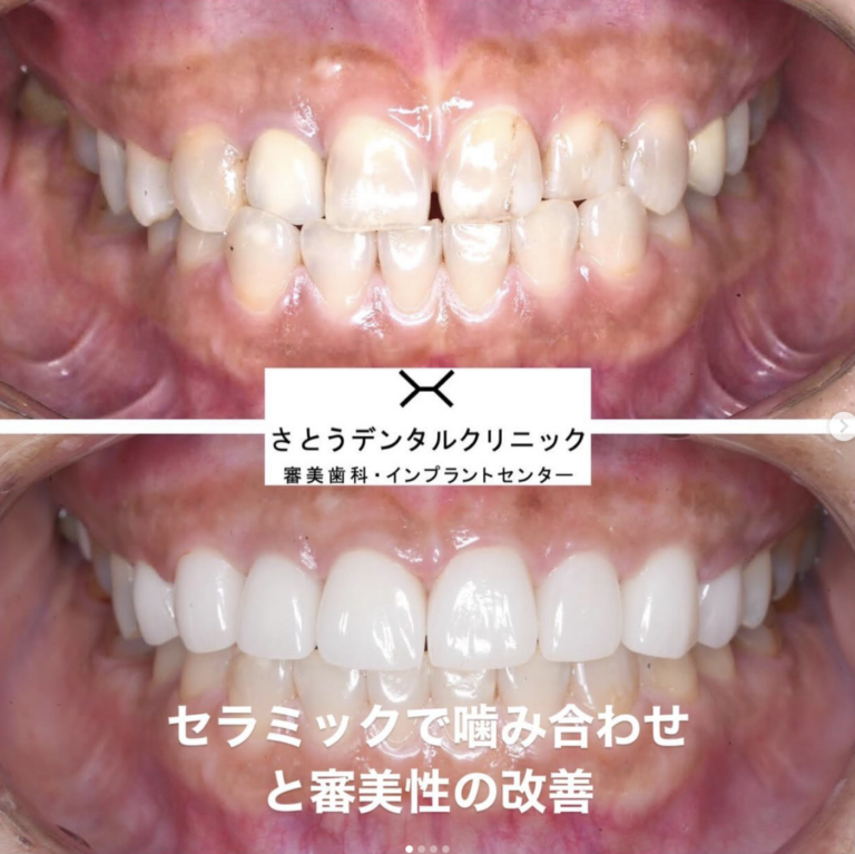 セラミック矯正