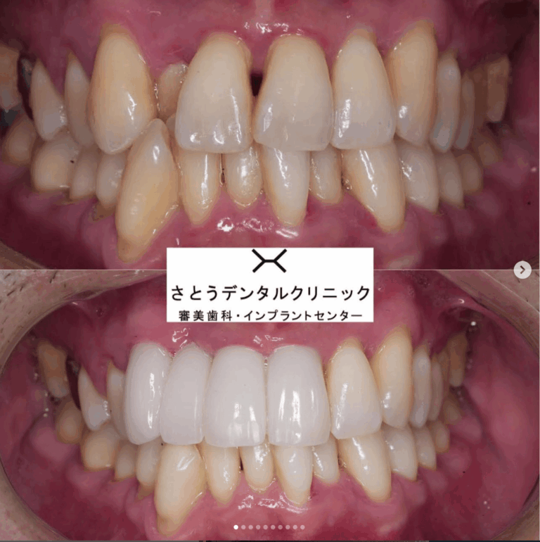症例写真 セラミック矯正