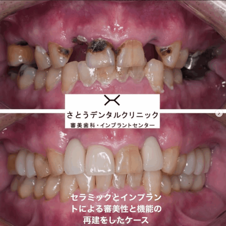 セラミック矯正