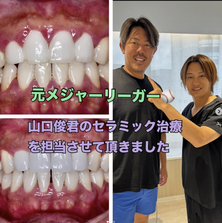 セラミック矯正