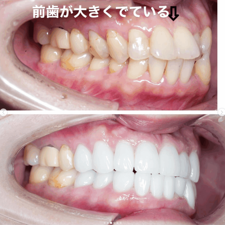 セラミック矯正