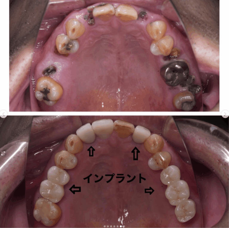 セラミック矯正