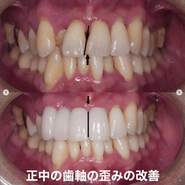 Case025 – セラミック矯正