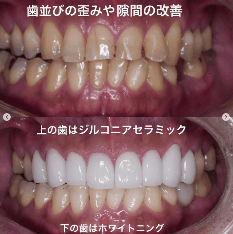 セラミック矯正