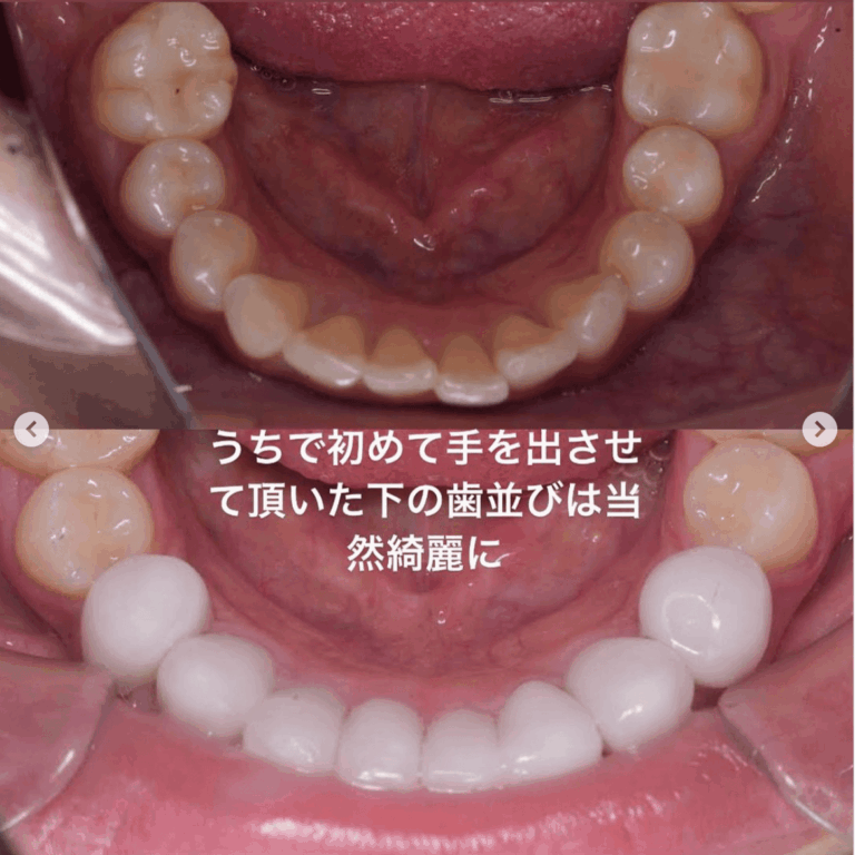 セラミック矯正
