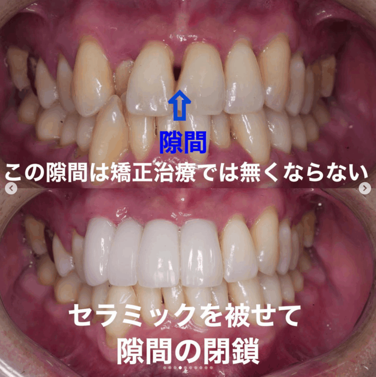 Case025 – セラミック矯正