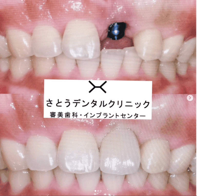 インプラント