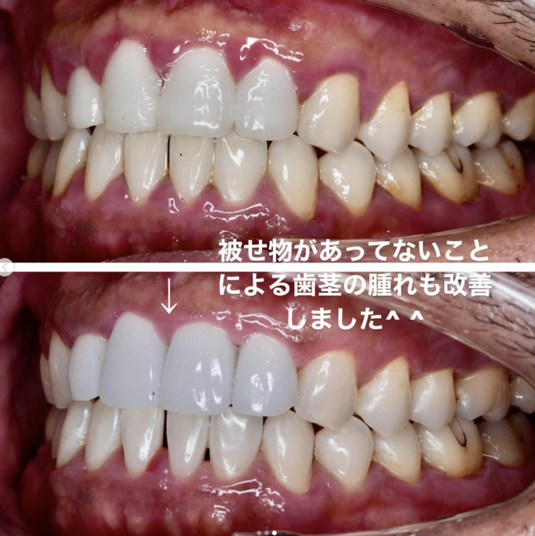セラミック矯正