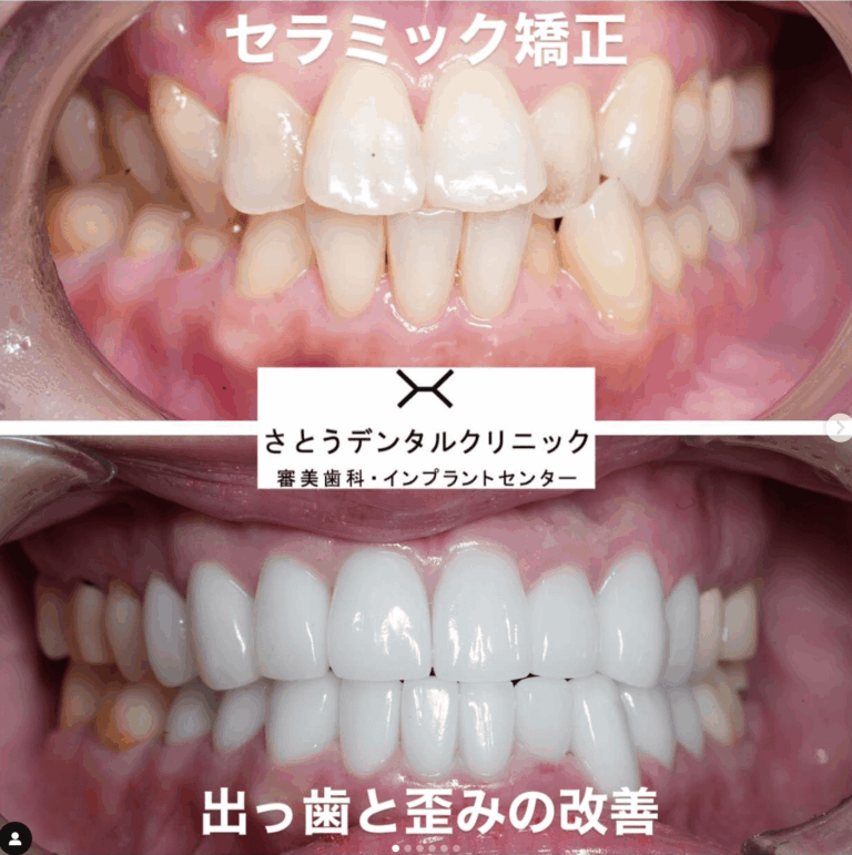 セラミック矯正