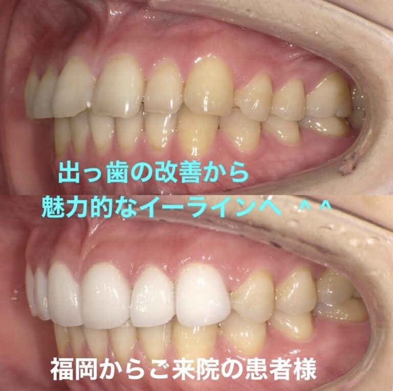 Case013 – セラミック矯正