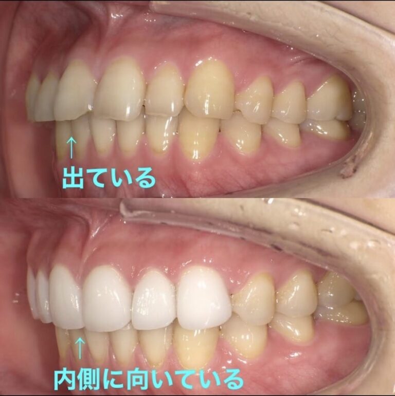 Case013 – セラミック矯正