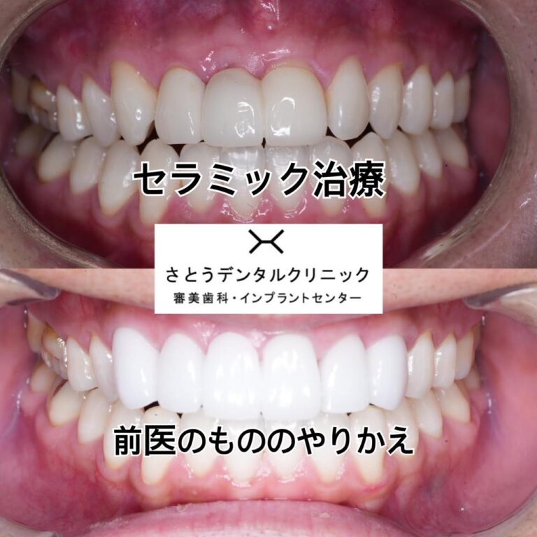 Case024 – セラミック矯正