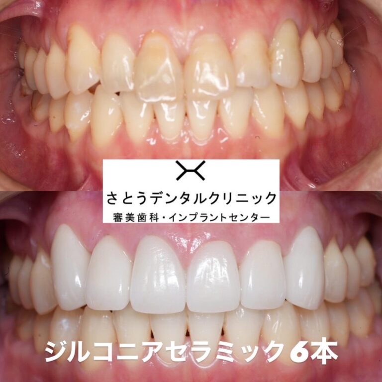 セラミック矯正