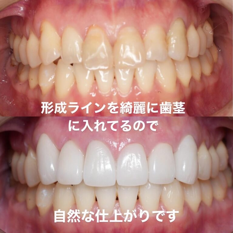 セラミック矯正
