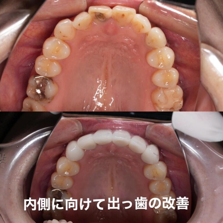 セラミック矯正