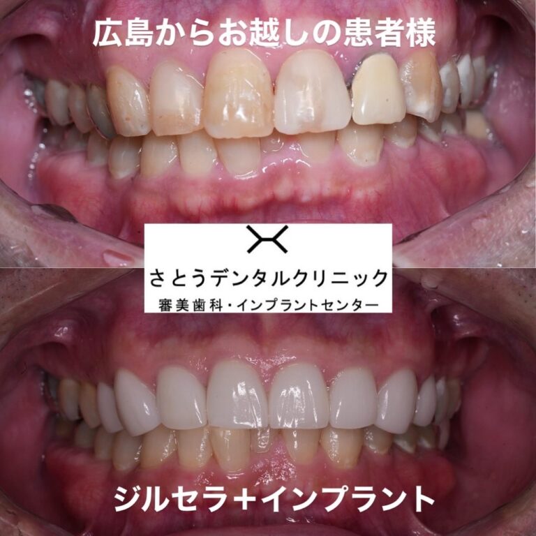 ジルセラ＋インプラント