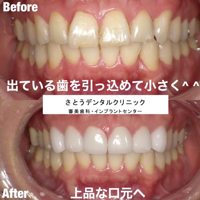 Case009 – セラミック矯正