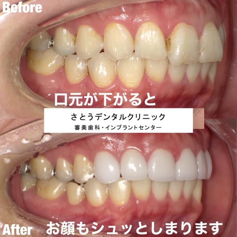 Case009 – セラミック矯正