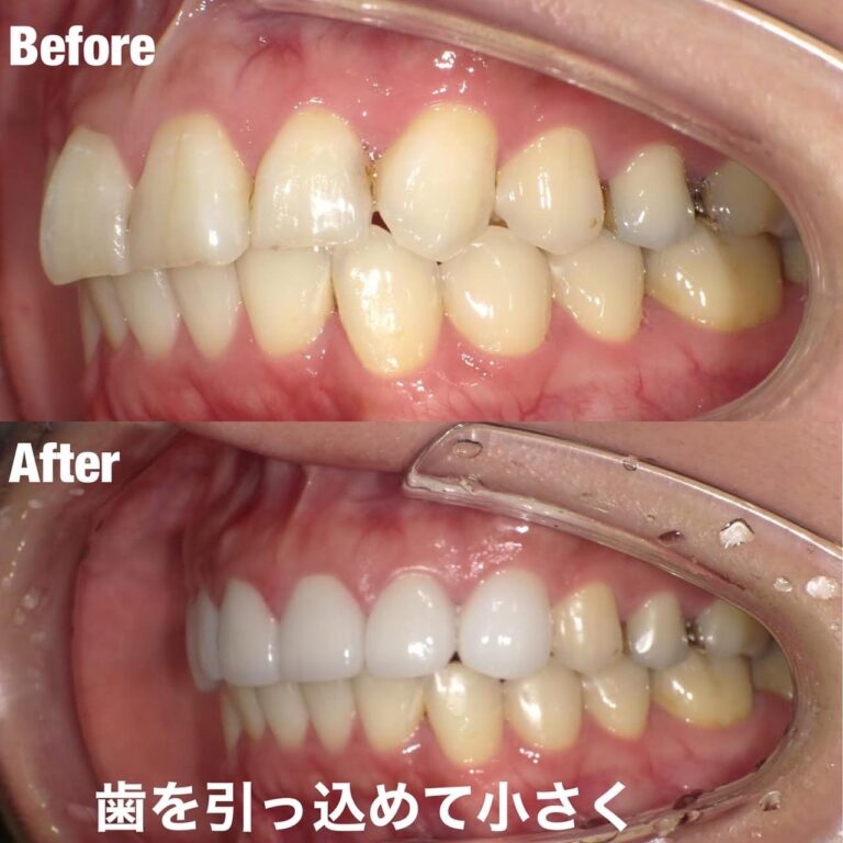 Case009 – セラミック矯正