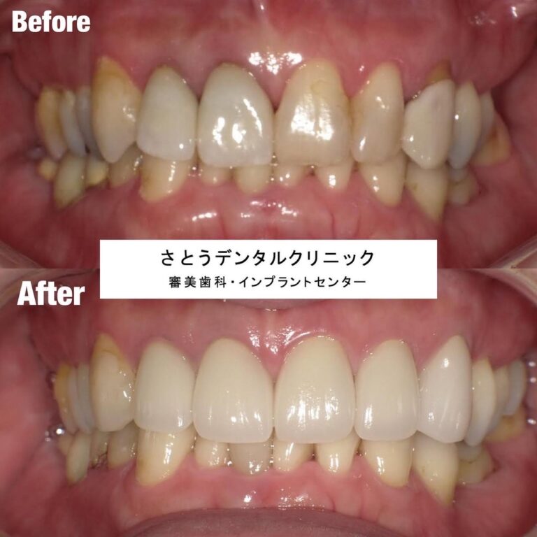 セラミック矯正