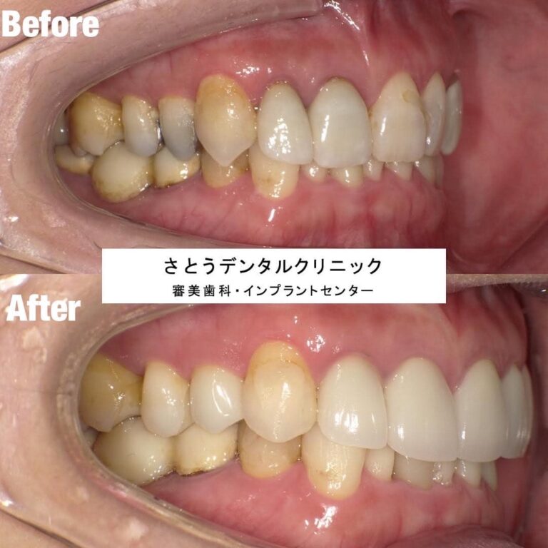 セラミック矯正