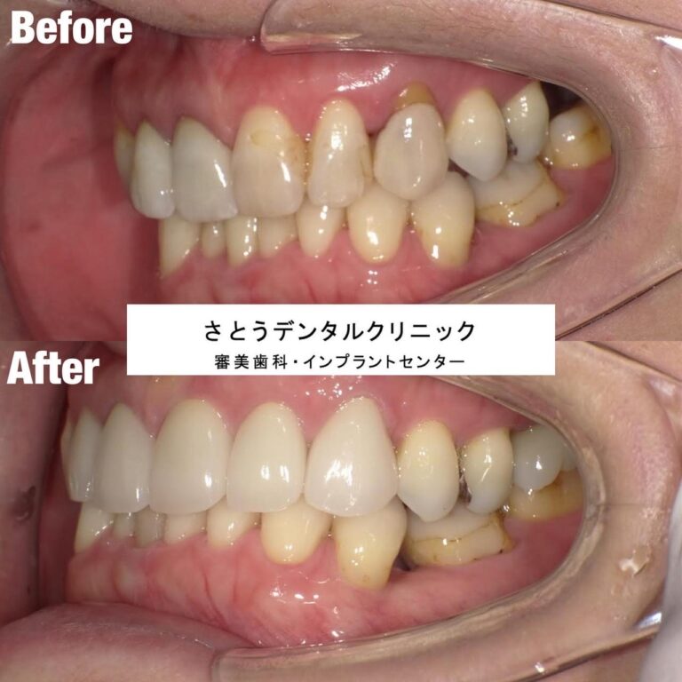 セラミック矯正