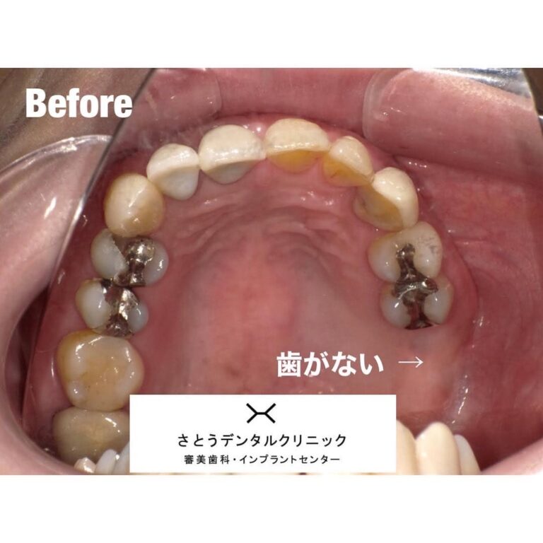 セラミック矯正