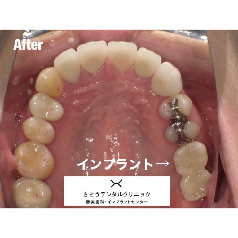 セラミック矯正
