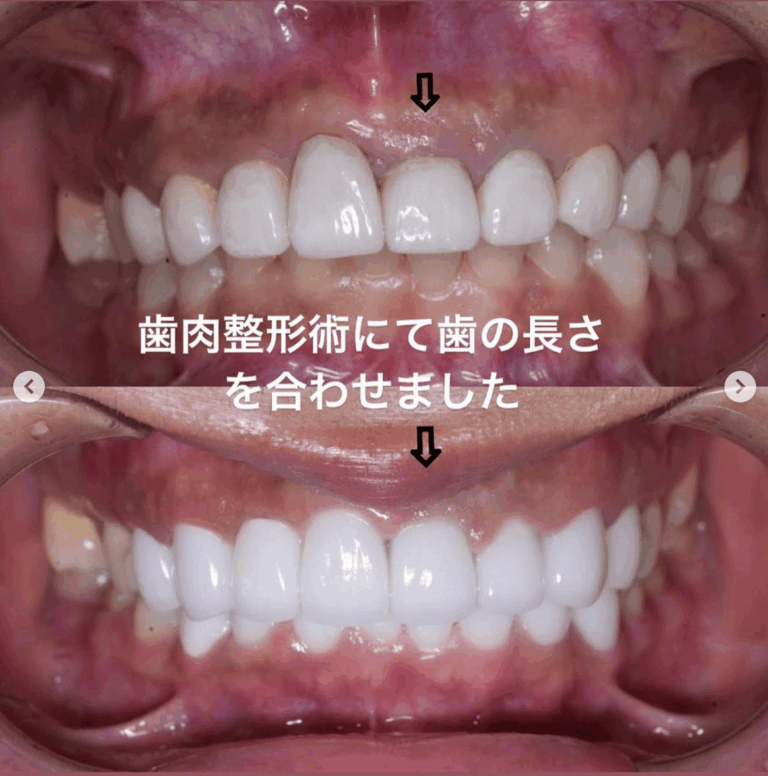 セラミック矯正