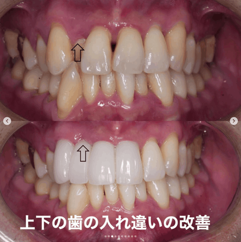 Case025 – セラミック矯正