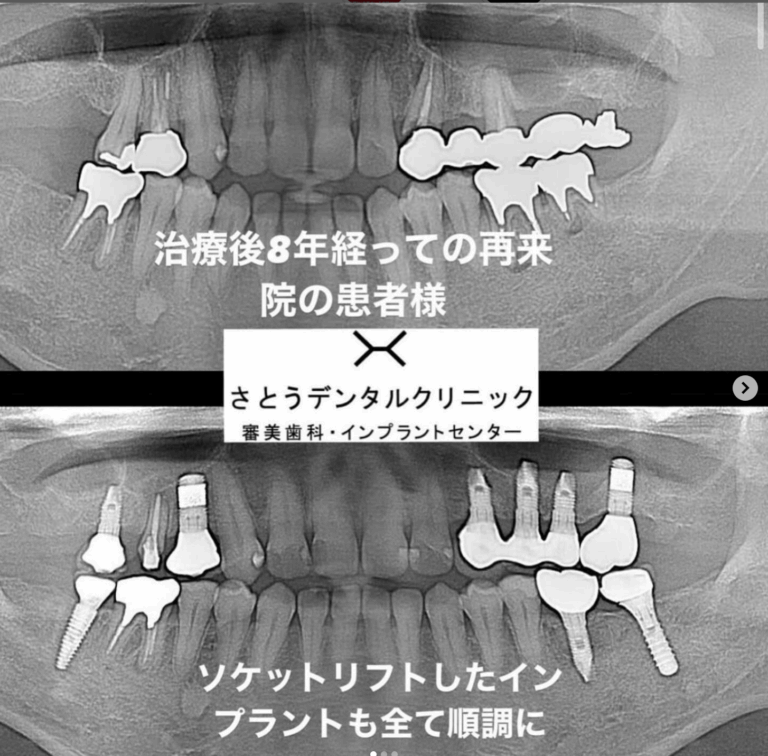 インプラント