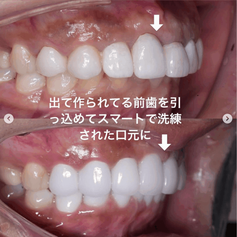 セラミック矯正