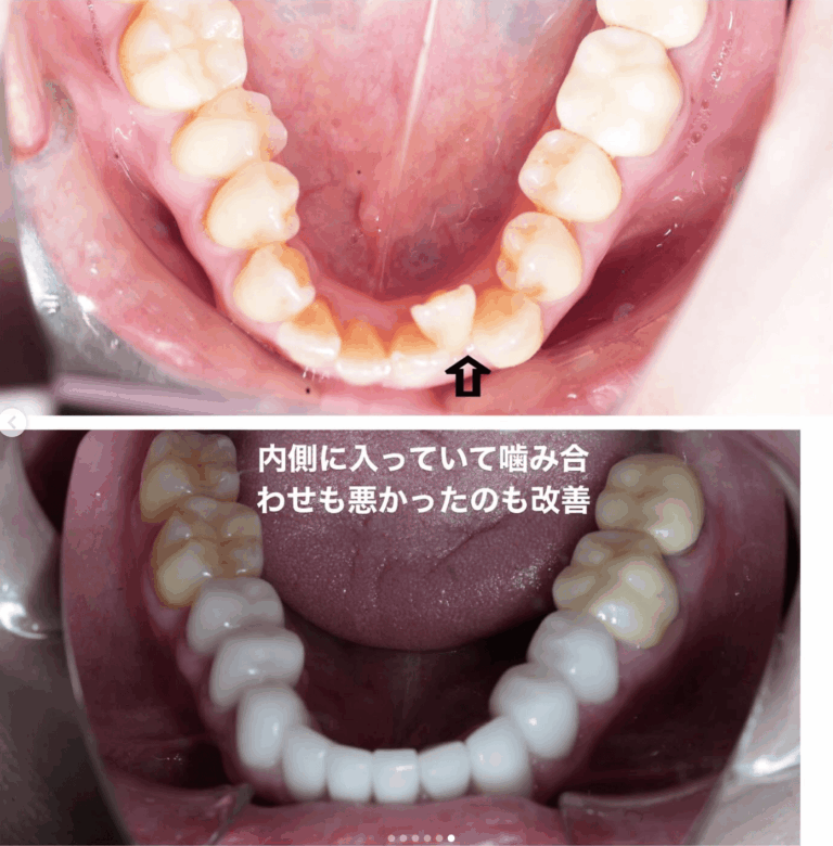 セラミック矯正