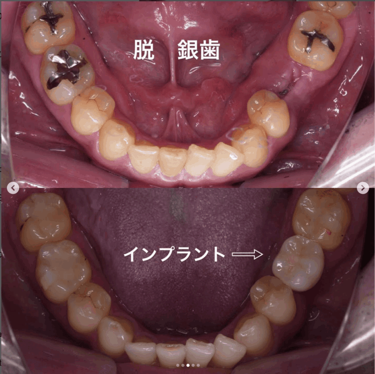 症例写真 ホワイトニング / セラミック矯正 / インプラント