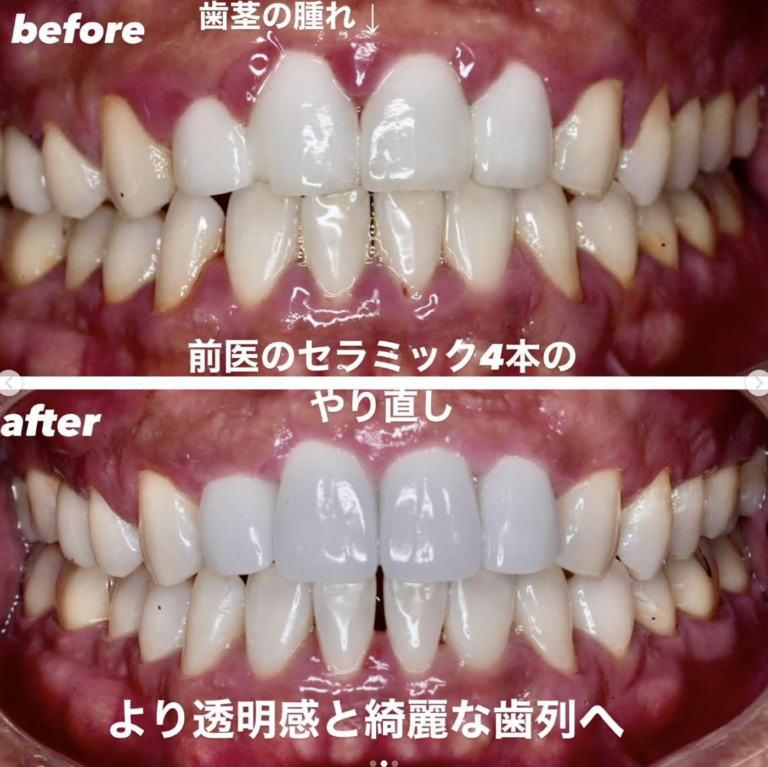 セラミック矯正