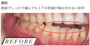 開咬